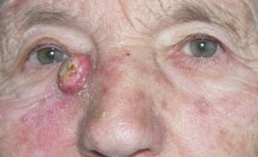Gyorsan növekvő tumor.