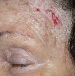 3 éve más intézményben eltávolított rosszindulatú tumor kiújulása (recidívája) a homloktájon. 