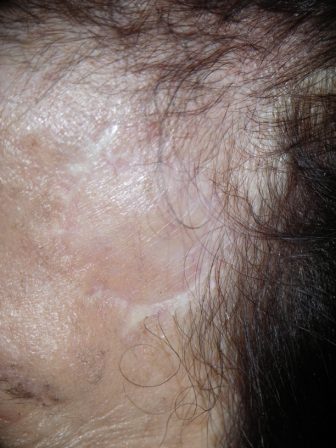 A tumor eltávolítása után 2 hónappal (szabad bőrátültetés történt a fül mögül). Az átültetett bőr teljesen besimul a befogadó környezetbe.