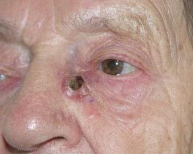 Rosszindulatú tumor az orrgyökön. 