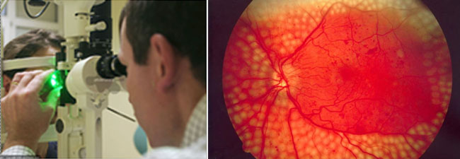 Súlyos, azonnali kezelést igénylő diabeteszes retinopathia. Az erek között vérzések és vizenyő jelei láthatók. Kisfokú károsodás esetén (mikroaneurizmák, kicsiny vérzések) elrendeljük a belgyógyászati és diabetológiai kontrollt, továbbá sűrítjük a szemfenék vizsgálatok gyakoriságát is. Amennyiben a betegség súlyosbodik, szemfenéki lézerkezelés szükséges. Ez lehet csak egy-egy területre korlátozott vagy akár a teljes szemfenék (pánretinális) lézerkezelése. Ez utóbbi szemenként minimum 3 alkalmat vesz igénybe. Érzéstelenítő és pupillatágító csepp adása után az ambuláns kezelés időtartama 3-10 perc.