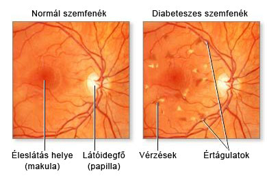 A cukorbetegség szemtünetei A cukorbetegség az apró ereket teszi tönkre: ezek merevvé és törékennyé válnak az egész szervezetben. Az erekből vérplazma szivárog ki, vérzések alakulnak ki. Ezek jelenléte miatt a szemben a látóhártya nagyon finom szövete károsodik. A meggyengült erek kidudorodnak, ún. mikroaneurizmák jönnek létre. A vérellátás kórosodása miatt romlik a látóhártya oxigénellátása, olyan anyagok szabadulnak fel, amelyek új erek kialakulását serkentik. Ez az érújdonképződés (neovszkularizáció) nagyon veszélyes: az ilyen erek méginkább törékenyek, belőlük nagy, az egész szemgolyót kitöltő vérzés indulhat meg. Az érújdonképződés másik veszélye, hogy növekedésével az ideghártyát elemeli az alapjától és vakságot okozó ideghártya-leválás alakul ki.