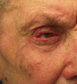 2 héttel a rekonstrukció után (varratszedés, sebtisztítás, felső és alsó szemhéjplasztika, canthopexia történt)