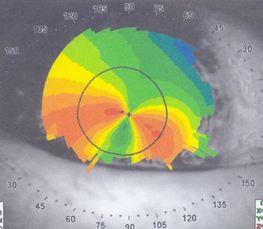 Keratoconus pellulicid marginális degeneráció