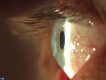 Keratoconus