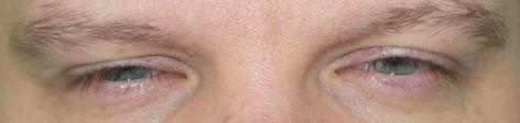 Kétoldali felső szemhéjcsüngés