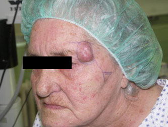 Orrgyöki rosszindulatú tumor és eltávolítás után másfél hónappal.(rekonstrukció: kettős lebenyelforgatás)