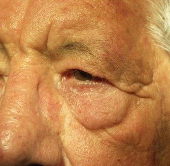 Páciensünk szemöldöke annyira megereszkedett, hogy oldalt a szemrés magasságát is elérte. Jelentős bőrtöbblet alakult ki a felső és alsó szemhéjakon. Mindez már látásában is zavarta, továbbá állandó irritációt okozott.